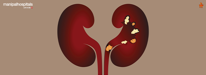 Understanding Kidney Stone Causes, Symptoms, and Treatment Options