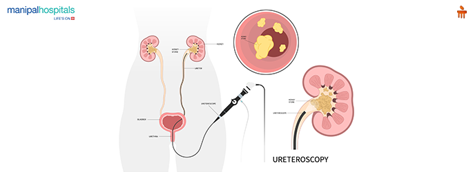 Kidney Stone Treatment