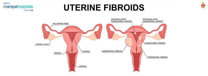 uterine fibroids symptoms
