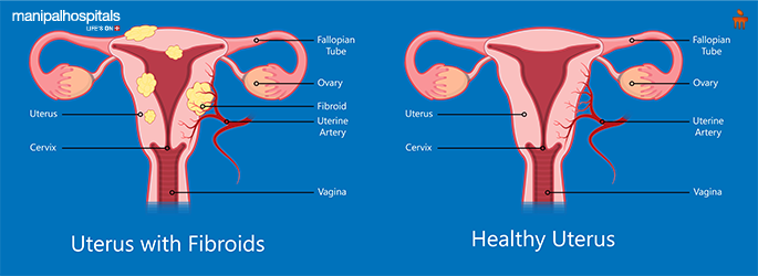 Uterine fibroids symptoms diagnosis and treatment