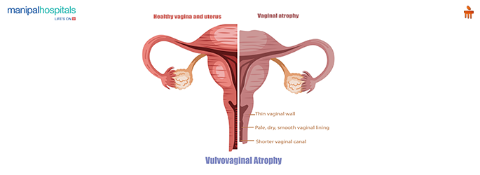 Vaginal Atrophy Treatment