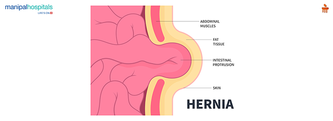 open hernia surgery