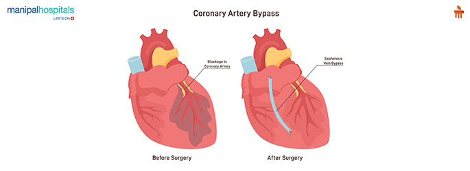 chest pain causes