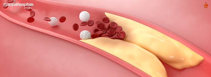 What Causes Blocked Heart Arteries? Signs, Treatment & Prevention