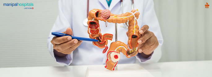 Colorectal Cancer Treatment: Symptoms, Causes & Care Guide