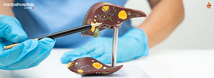 What is Non-Alcoholic Fatty Liver Disease? Causes, Symptoms & Treatment Options Understanding Fatty Liver Without Alcohol: A Complete Guide
