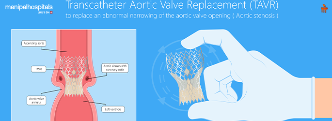 TAVR heart surgery