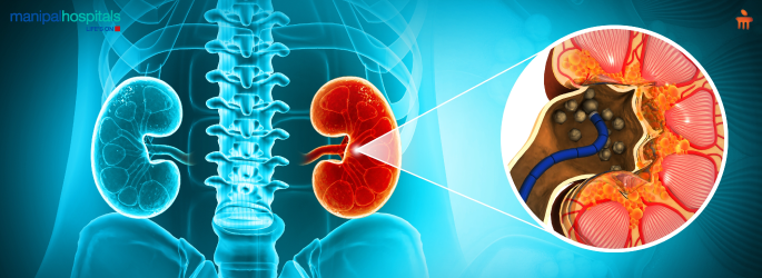 What is the Difference Between Acute Renal Failure and Chronic Kidney Disease?