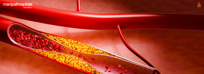 What Causes High Triglycerides and How to Manage Them Effectively