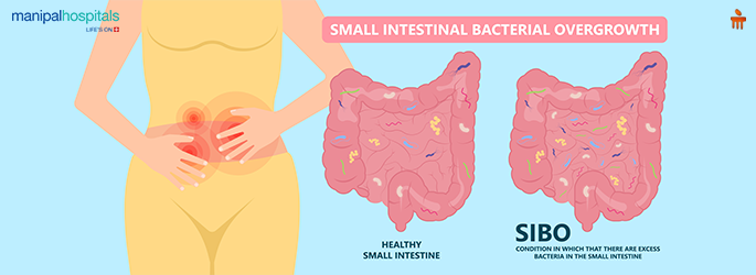 sibo symptoms