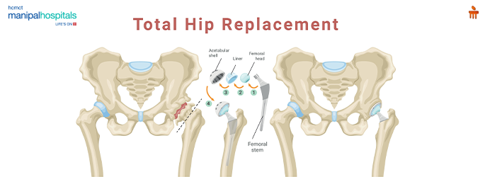 Total Hip Replacement Surgery