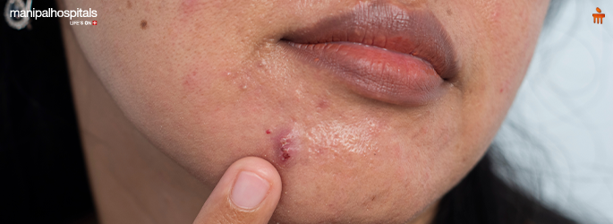 When a Pimple May Be More Than Acne: Understanding Early Skin Cancer