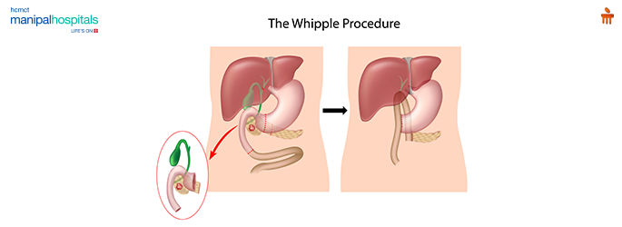 Whipple procedure for pancreatic cancer