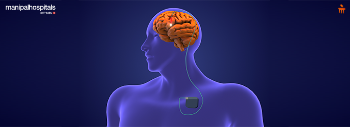 Deep Brain Stimulation: Are You the Right Candidate