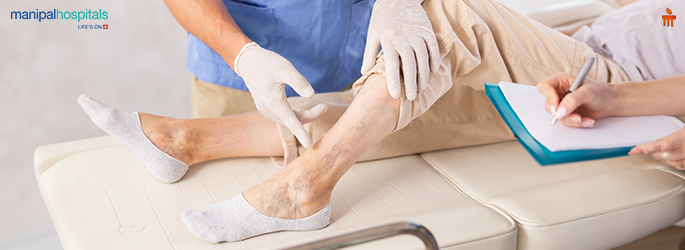 Varicose Veins: Don’t Ignore Leg Discomfort