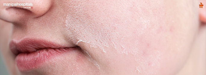Winter Skin Problems: Common Causes and Simple Ways to Protect Your Skin