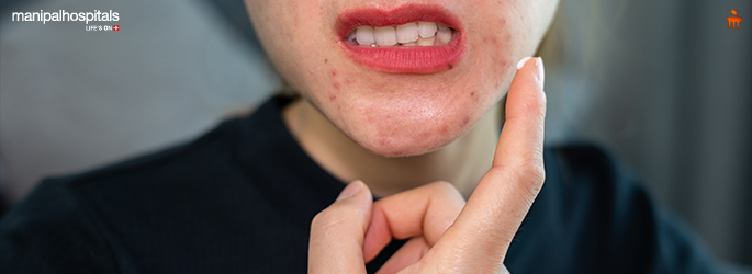 acne skin condition