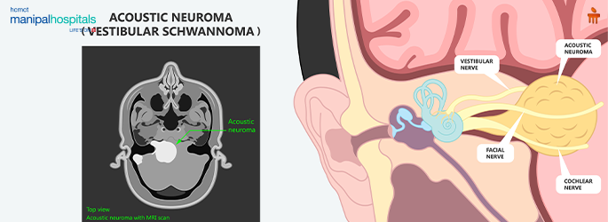 Acoustic Neuroma