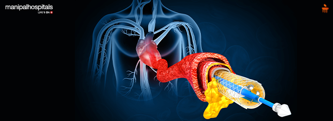 angioplasty procedure