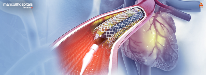 angioplasty-vs-bypass-surgery