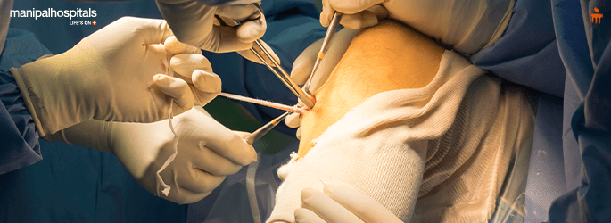 Anterior Cruciate Ligament (ACL)