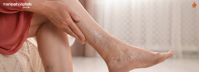 Varicose Veins in the Legs: Early Signs, Diagnosis, and Minimally Invasive Care