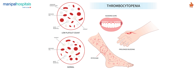 Best Hematology Hospital in Mysore