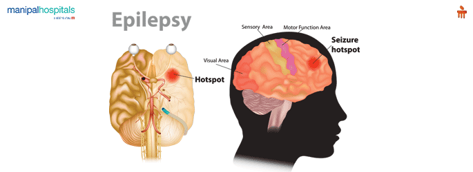 Best Neurology Hospital in Millers Road Bangalore