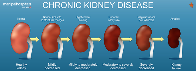 best kidney transplant hospitals in delhi