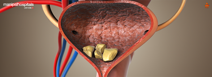 Bladder Stone Symptoms