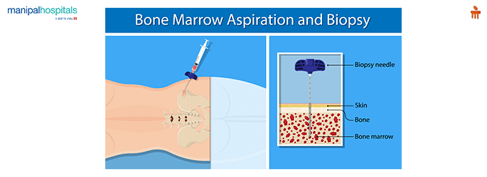 Bone Marrow Cancer Treatment in Mysore