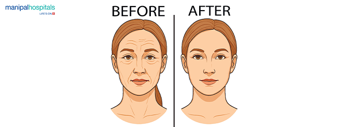 Botox treatment