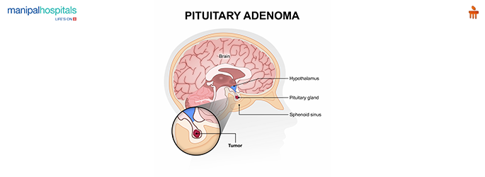 brain-tumor-surgery-preparation-procedure-aftercare