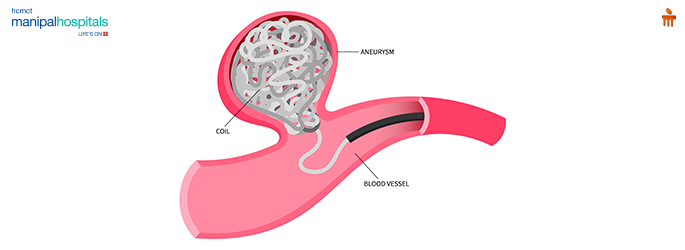 brain aneurysm coiling