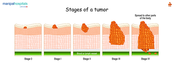 cancer staging