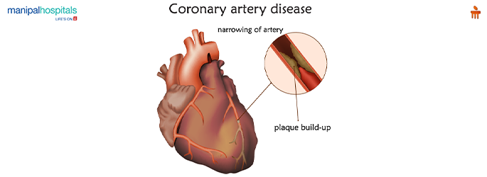 Coronary Artery Disease (CAD) It's Risk Factors & Prevention