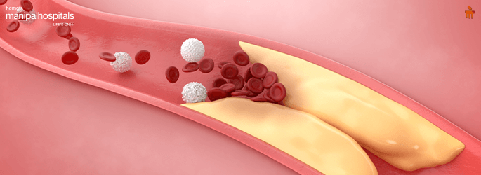 Coronary Artery Disease (CAD): Symptoms and Prevention