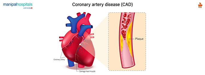 Coronary Artery Disease Symptoms