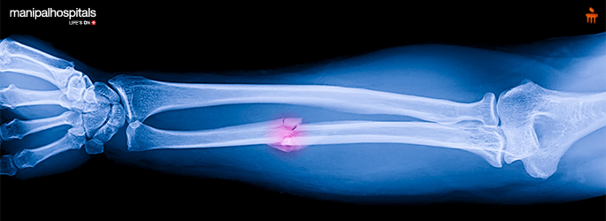 Fracture Healing Warning Signs