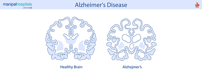 Alzheimer’s disease symptoms