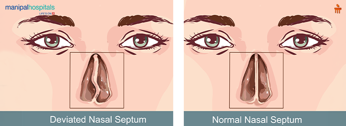 deviated septum