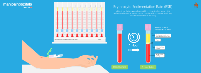 Erythrocyte Sedimentation Rate Explained