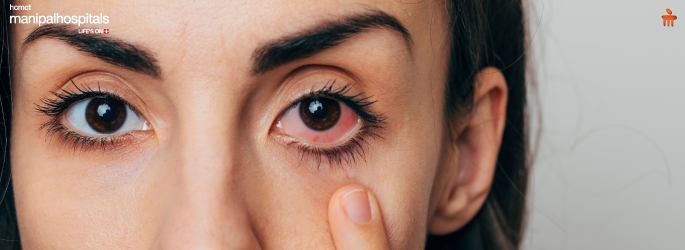 Eye Flu: Causes, Symptoms, Treatment, and Prevention