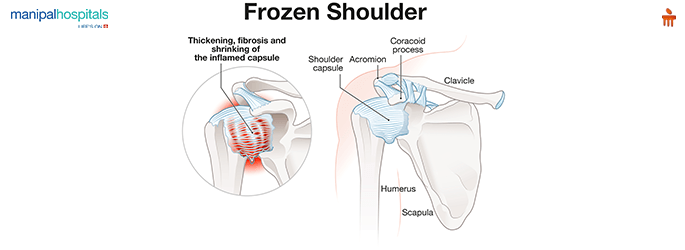 Frozen Shoulder Treatment