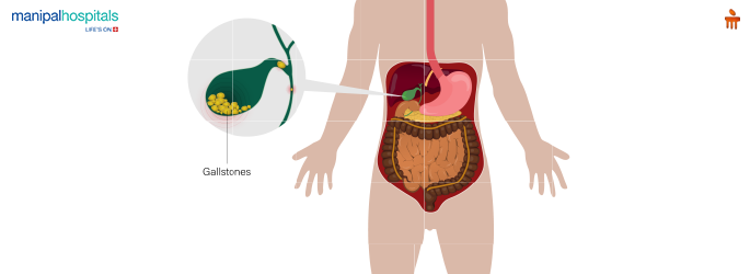 Gallbladder Stones Signs, Symptoms, Treatment, Recovery