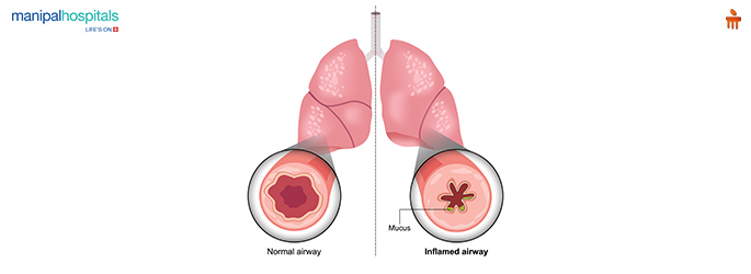 Gas Trouble in Chest: Symptoms, Causes, and Relief Options