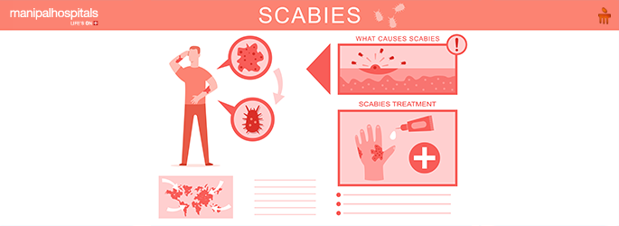 how to get rid of scabies