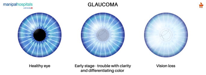 Glaucoma: symptoms, causes, treatment