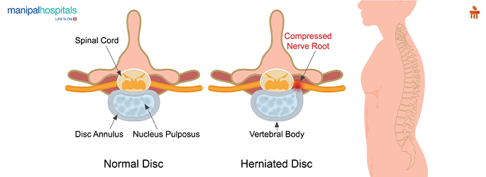 herniated disc surgery