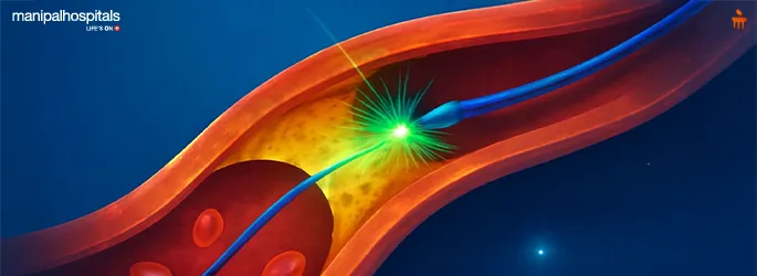 How Laser Angioplasty is Revolutionising Heart Care